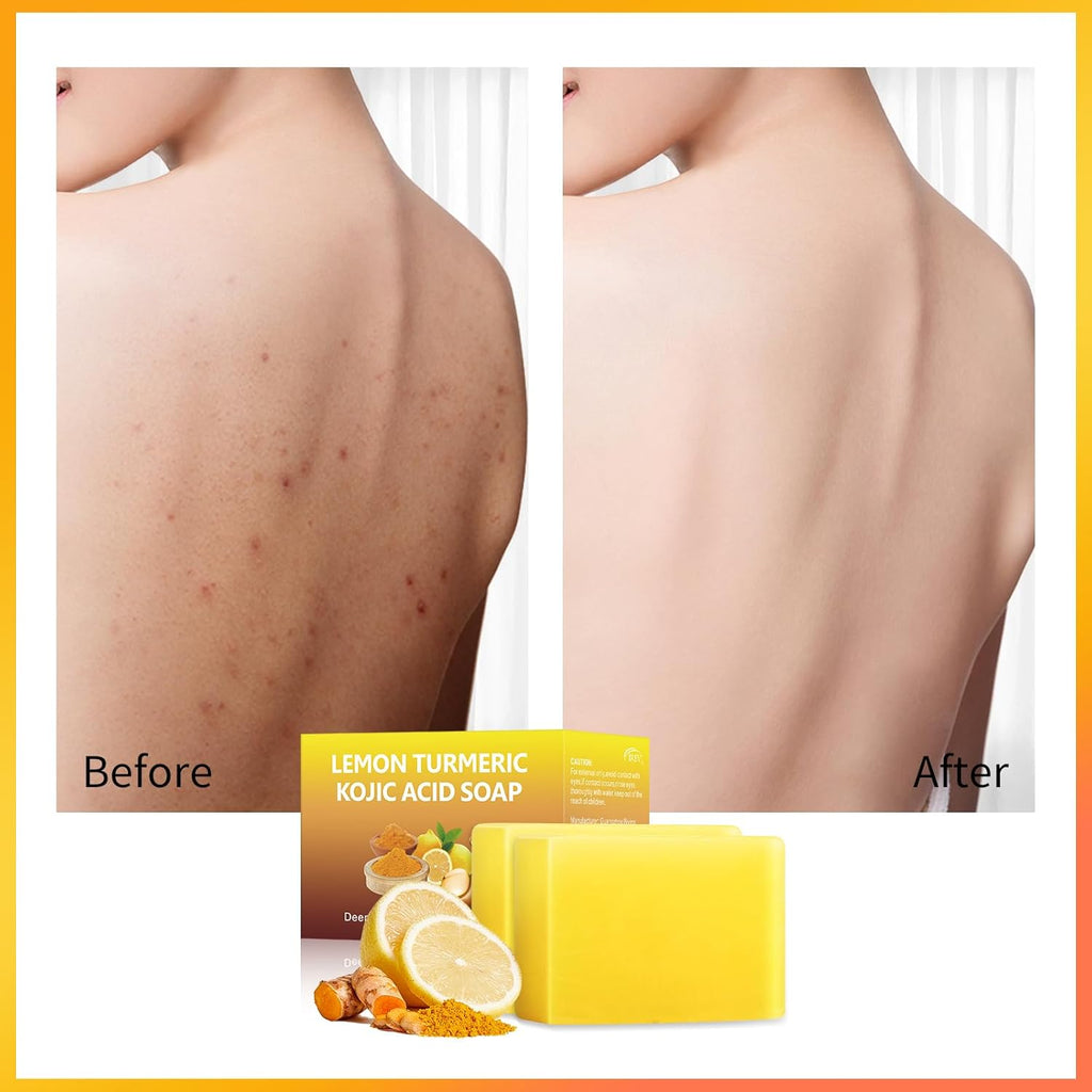 Tamoskiny Lemon Turmeric Kojic Acid Soap Bar for Hyperpigmentation, 2 Pack K75405